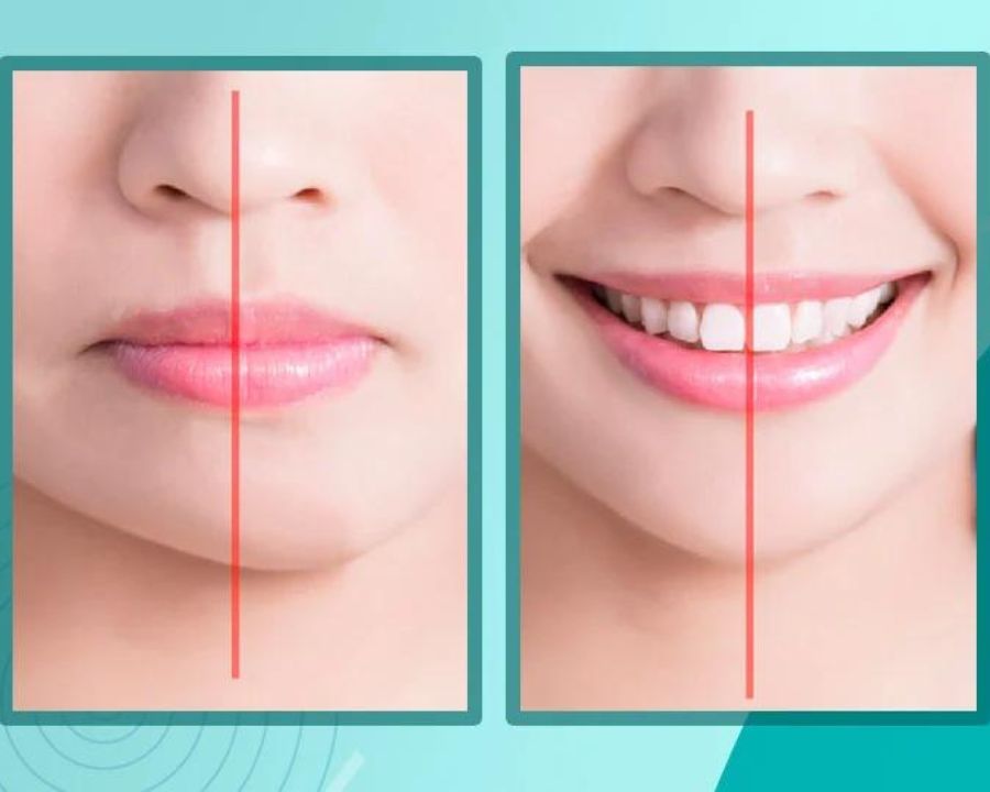 Nhân trung ở đâu? Tướng số nhân trung dài, rộng, sâu, ngắn - Ảnh 10